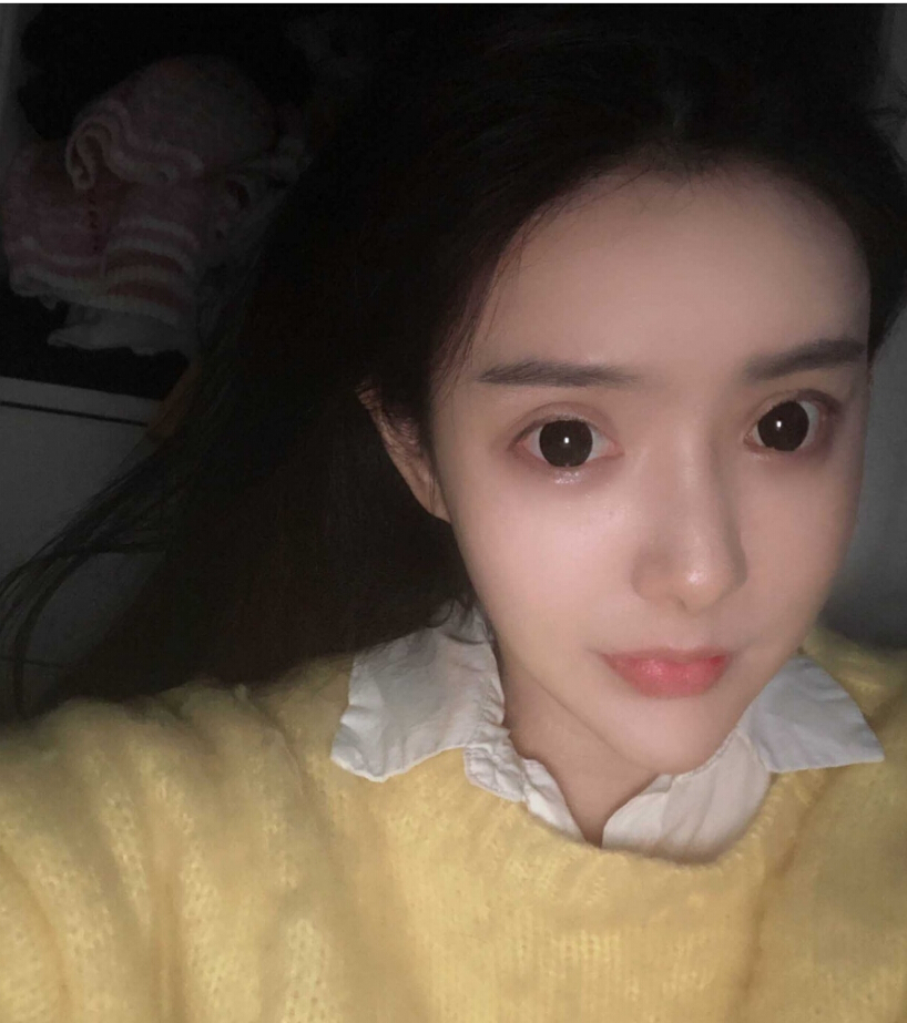 重慶柏漫醫(yī)療美容診所高紅艷醫(yī)生做面部吸脂怎么樣？面部吸脂案例分享