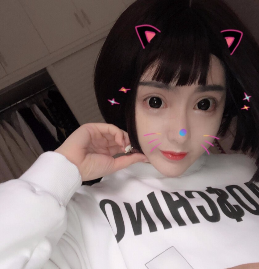 重慶柏漫醫(yī)療美容診所高紅艷醫(yī)生做面部吸脂怎么樣？面部吸脂案例分享