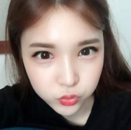 象山華美整形美容醫(yī)院趙誠厚醫(yī)生做切開雙眼皮+開內(nèi)眼角整形案例