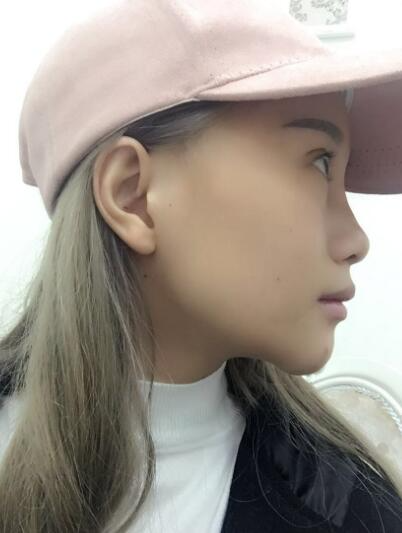 長(zhǎng)春奧拉克美容醫(yī)院金相勛醫(yī)生做玻尿酸豐臥蠶怎么樣？附案例