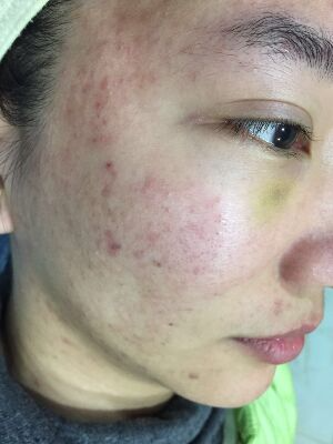 重慶柏漫醫(yī)療美容診所做激光祛痘效果怎么樣？白亞亞激光祛痘案例