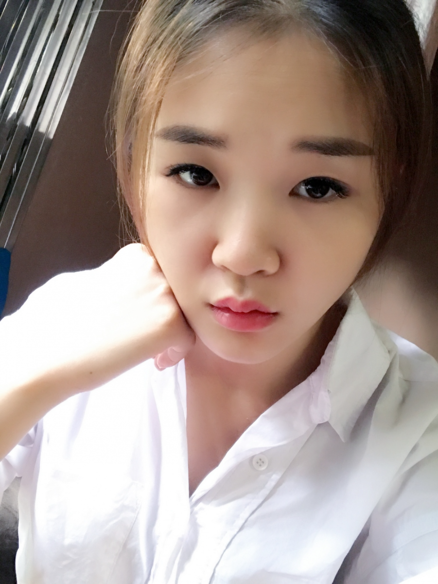 鄭州華領(lǐng)醫(yī)療美容醫(yī)院賀小虎醫(yī)生做眼綜合+鼻部整形手術(shù)效果怎么樣？