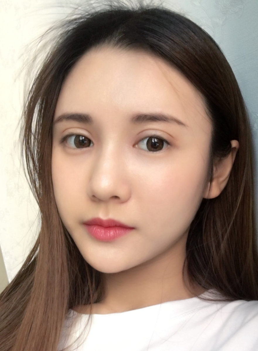 鄭州銘藝整形醫(yī)生陳濤做切開雙眼皮怎么樣？鄭州銘藝切開雙眼皮案例