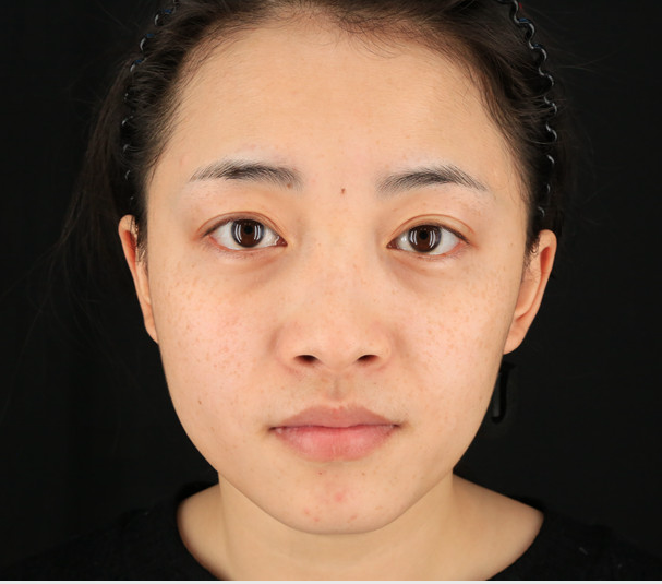 重慶當代整形李敏旭醫(yī)生做皮秒激光祛斑效果怎么樣？附皮秒激光祛斑案例