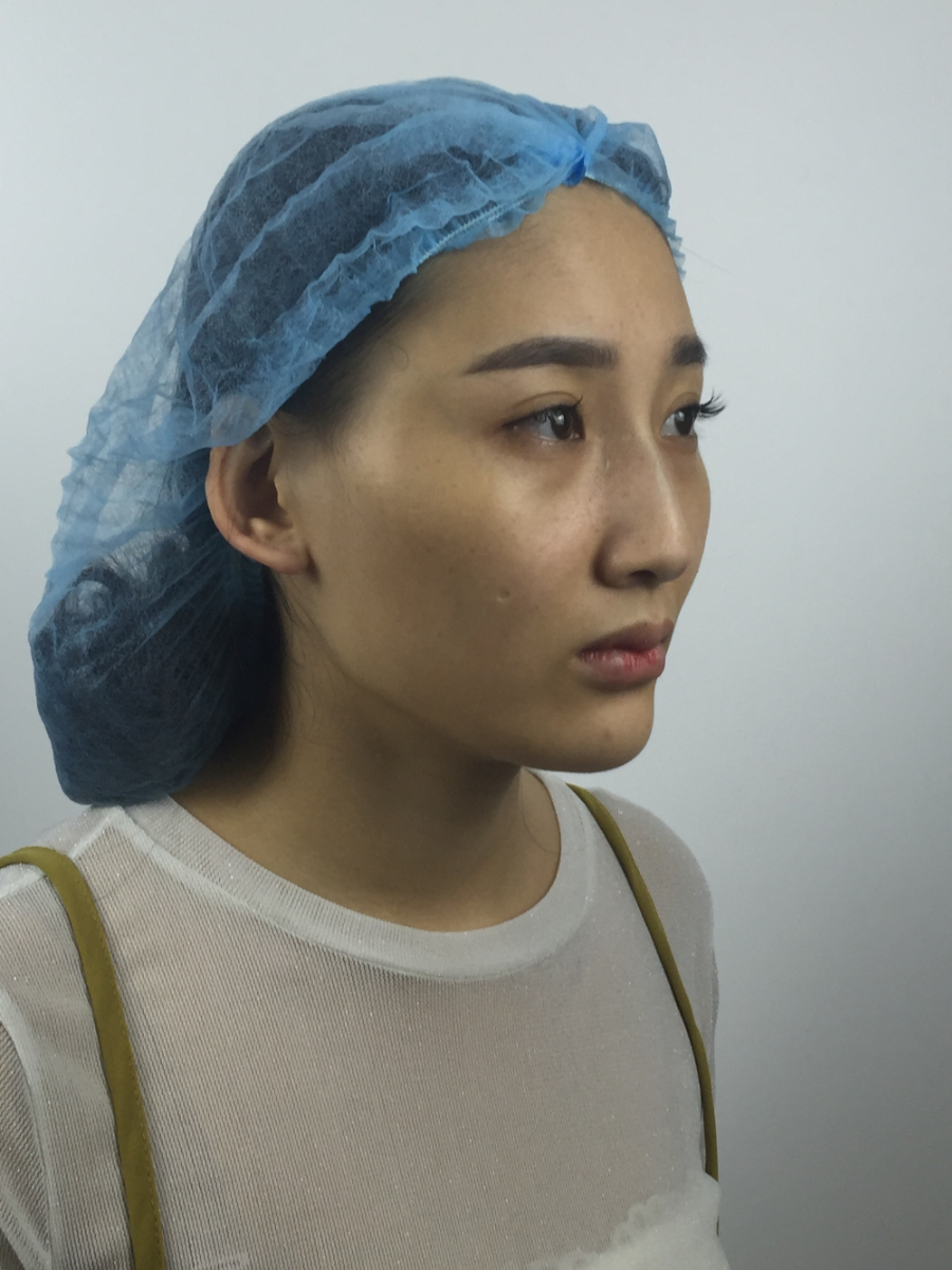 武漢中翰整形外科醫(yī)院沈磊醫(yī)生做切開雙眼皮怎么樣？附沈磊切開雙眼皮案例