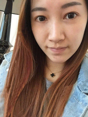 重慶五洲女子醫(yī)院整形美容中心做光子嫩膚怎么樣？淡明斌醫(yī)生光子嫩膚案例