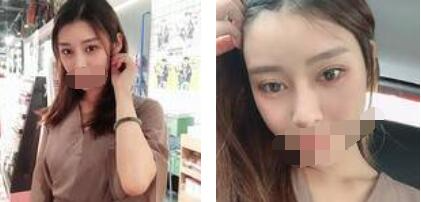 太原歐美蓮整形醫(yī)院丁曉峰醫(yī)生做雙眼皮怎么樣？丁曉峰雙眼皮手術(shù)案例分享