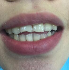武漢康承貝健口腔醫(yī)院宋磊醫(yī)生做二氧化鋯全瓷牙效果怎么樣？附案例