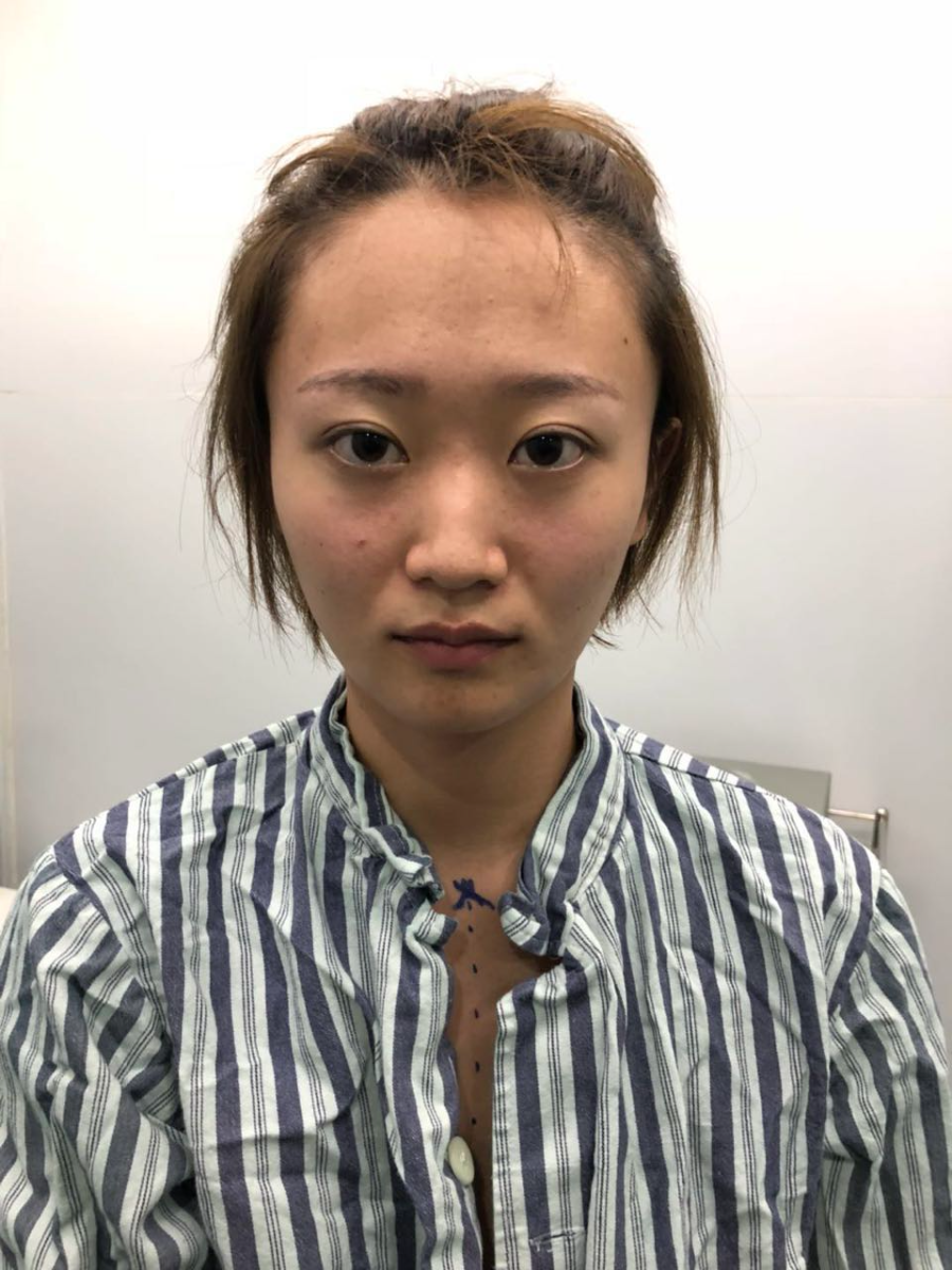 杭州迪美整形常德成醫(yī)生做鼻綜合整形技術(shù)怎么樣？附鼻綜合整形案例