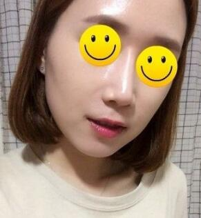 信陽東方藝美容醫(yī)院劉力萌做玻尿酸去法令紋效果怎么樣？附案例效果對比圖