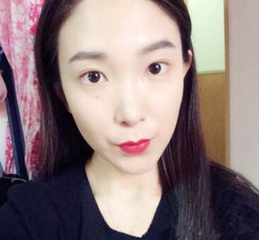 武漢中翰整形外科醫(yī)院陳志鵬醫(yī)生做雙眼皮修復(fù)效果怎么樣？附雙眼皮修復(fù)案例