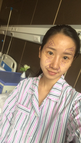 湛江澳泰整形醫(yī)院彭鑫醫(yī)生做自體脂肪豐蘋果肌+太陽(yáng)穴案例效果對(duì)比圖