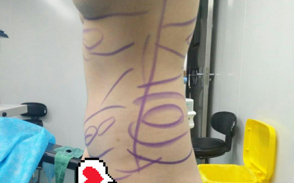 沈陽天使醫(yī)療整形醫(yī)生黃展翼做水動(dòng)力腰腹吸脂技術(shù)怎么樣？附水動(dòng)力腰腹吸脂案例