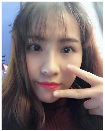 營口臻美醫(yī)療整形醫(yī)生閆迎軍做雙眼皮效果怎么樣？附雙眼皮案例對比圖