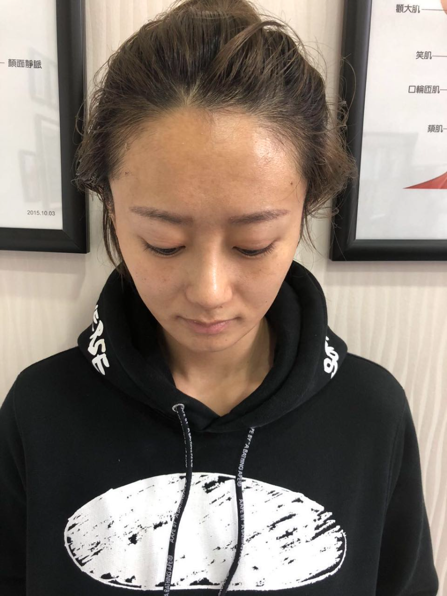 杭州迪美整形常德成醫(yī)生做鼻綜合整形技術(shù)怎么樣？附鼻綜合整形案例