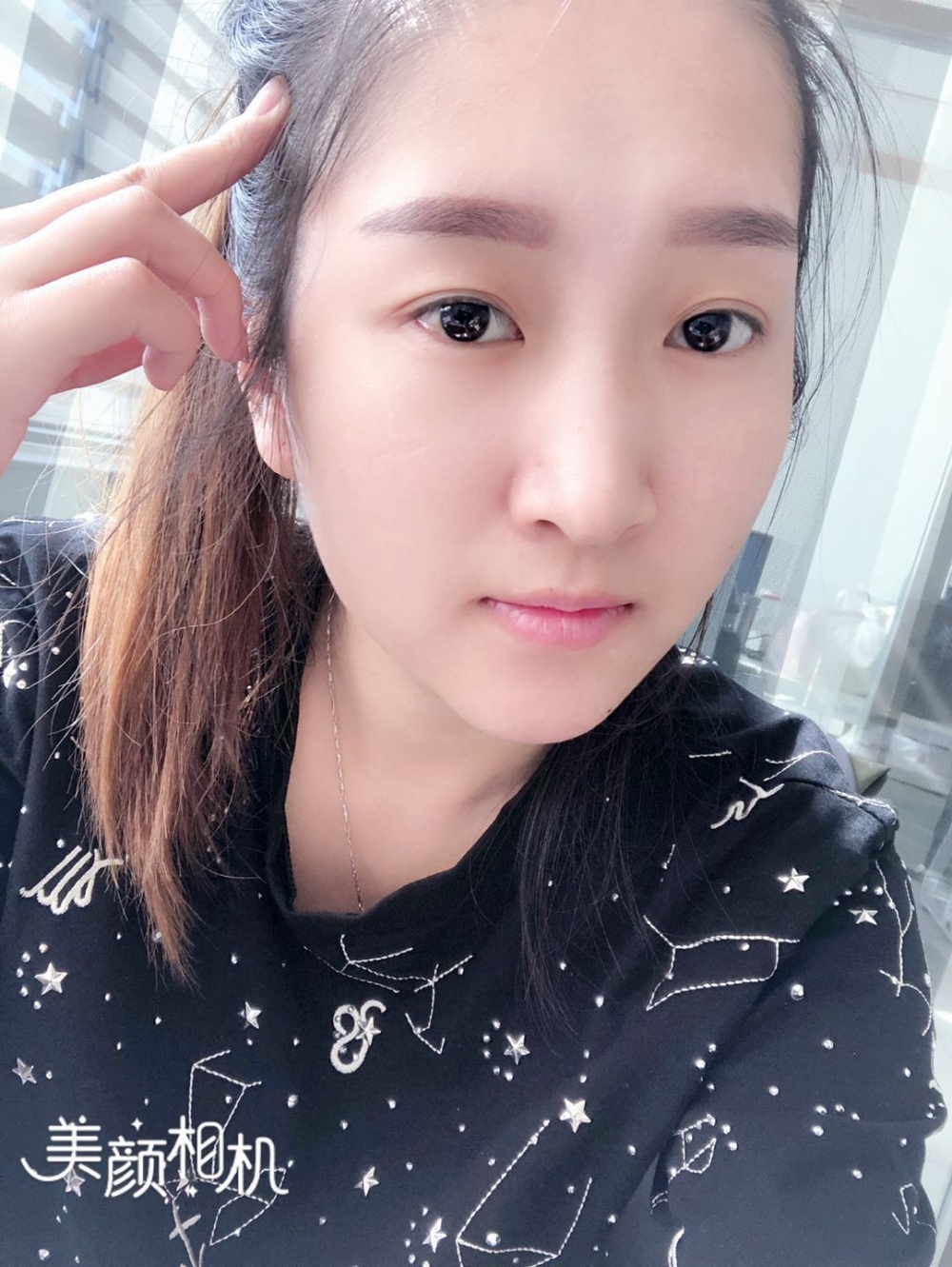 廣州廣大整形美容醫(yī)院任生醫(yī)生做玻尿酸豐面頰+注射瘦臉案例效果對(duì)比圖