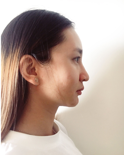 武漢維納斯整形醫(yī)院趙瑾醫(yī)生做玻尿酸墊下巴怎么樣？附玻尿酸墊下巴案例