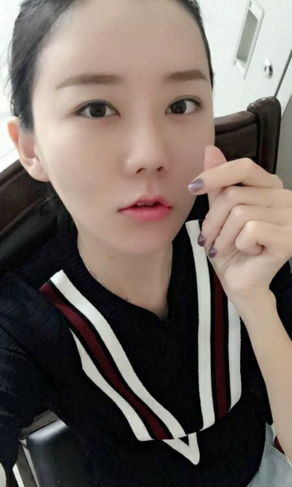 沈陽友誼整形美容醫(yī)院金顕哲醫(yī)生做自體脂肪填充臉部+V-LINE瓜子臉手術(shù)案例效果圖