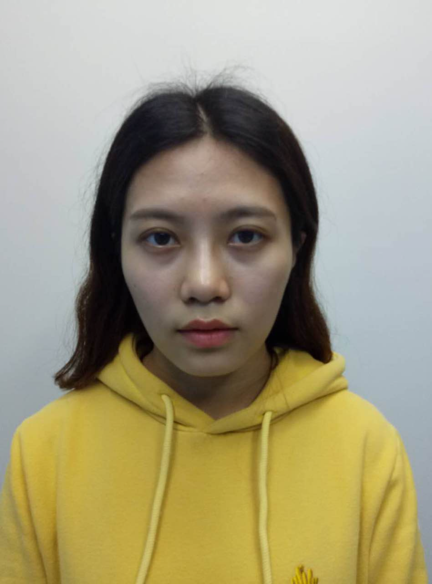 重慶美圣美邦整形醫(yī)院劉力維醫(yī)生做自體脂肪全臉填充案例效果對比圖