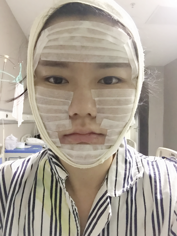 沈陽友誼整形美容醫(yī)院金顕哲醫(yī)生做自體脂肪填充臉部+V-LINE瓜子臉手術(shù)案例效果圖