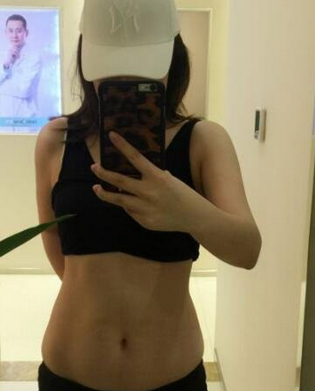 成都蜀尚蓉雅整形醫(yī)生張知華做腰腹吸脂效果怎么樣？附腰腹吸脂案例