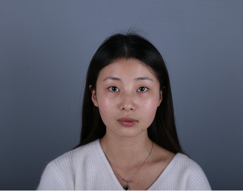 桂林新華醫(yī)療美容醫(yī)生李新華做雙眼皮手術怎么樣？李新華雙眼皮手術案例