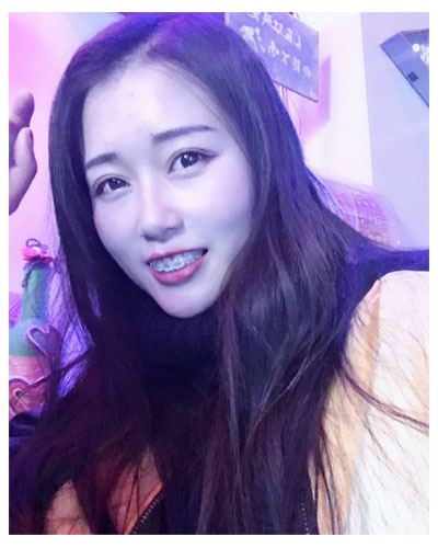 義烏傅氏口腔醫(yī)生朱雨晴做牙齒隱形矯正效果怎么樣？附牙齒隱形矯正案例