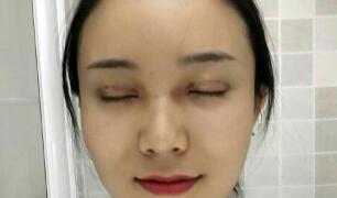 長(zhǎng)沙微笑醫(yī)療整形醫(yī)生段雙軍做切開雙眼皮+開內(nèi)眼角效果怎么樣？附案例