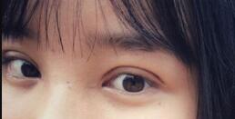 長(zhǎng)沙微笑醫(yī)療整形醫(yī)生段雙軍做切開雙眼皮+開內(nèi)眼角效果怎么樣？附案例