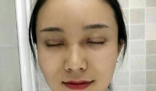 長沙微笑醫(yī)療整形醫(yī)生段雙軍做切開雙眼皮+開內(nèi)眼角效果怎么樣？附案例