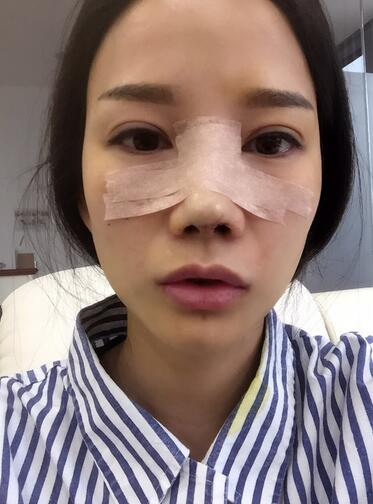 西安陽光整形醫(yī)院邵萍醫(yī)生做鼻綜合整形怎么樣？附鼻綜合整形案例