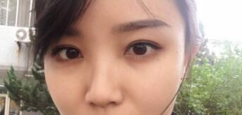 長沙微笑醫(yī)療整形醫(yī)生段雙軍做切開雙眼皮+開內(nèi)眼角效果怎么樣？附案例