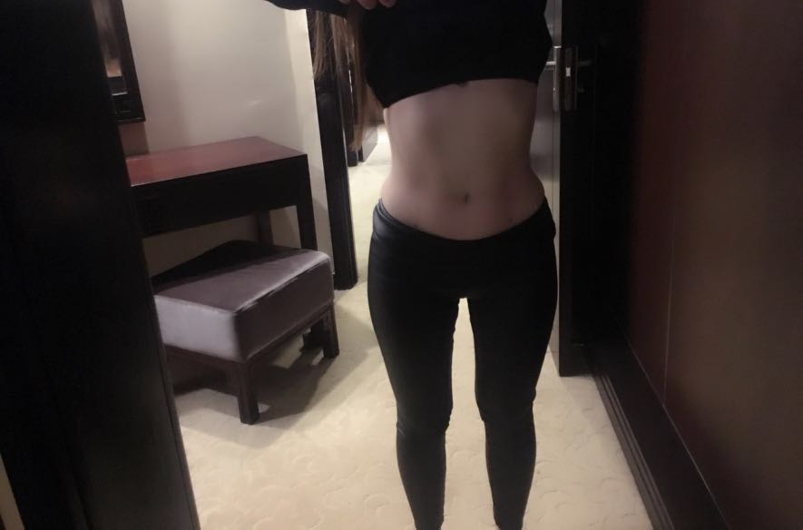 肇慶華美整形醫(yī)院陳巍醫(yī)生做腰腹吸脂效果怎么樣？附腰腹吸脂案例