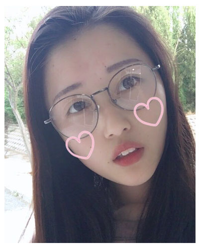 義烏傅氏口腔醫(yī)生朱雨晴做牙齒隱形矯正效果怎么樣？附牙齒隱形矯正案例