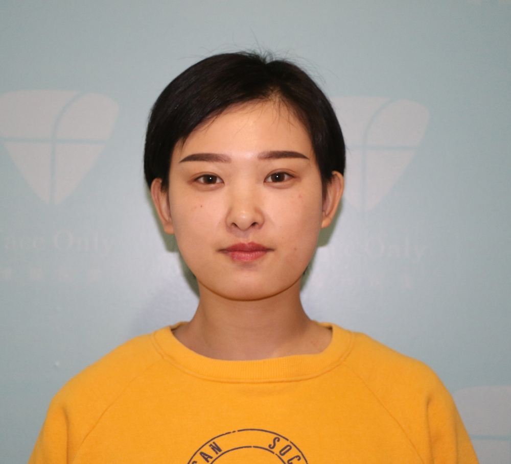 武漢肽慕醫(yī)美整形醫(yī)院楊婉菱醫(yī)生做面部吸脂效果怎么樣？附面部吸脂案例