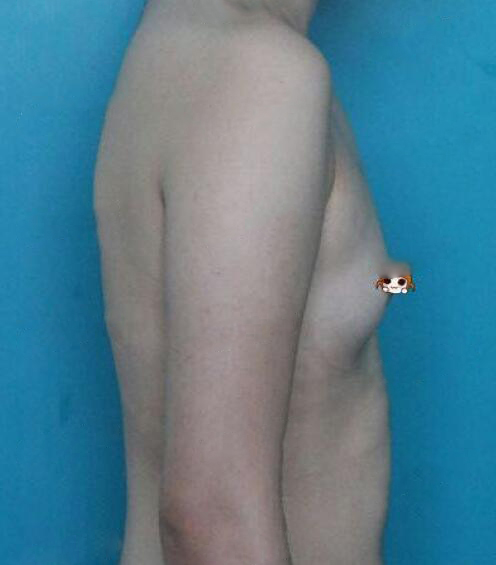 武漢華美整形醫(yī)院趙曉兵醫(yī)生做自體脂肪隆胸怎么樣？附自體脂肪隆胸案例