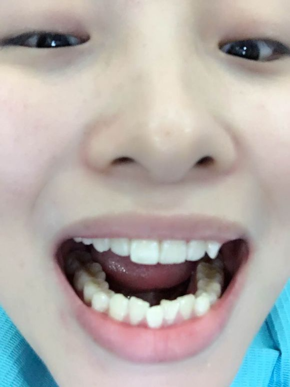 重慶齊美口腔周映丞醫(yī)生做牙齒隱形矯正怎么樣？附牙齒隱形矯正案例