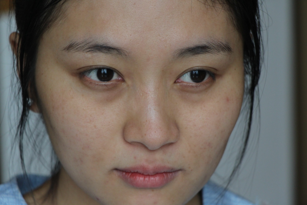 哈爾濱禾力康整形醫(yī)院劉亞春醫(yī)生做點陣激光去痘印效果怎么樣？附案例