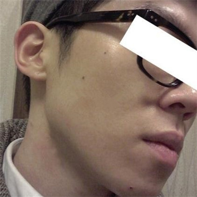 浙江綠城醫(yī)院整形美容中心丁路醫(yī)生做激光祛痘效果怎么樣，附案例對比圖