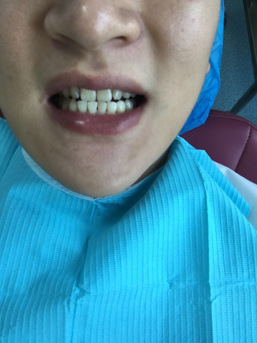 淮北博愛口腔醫(yī)院做牙齒瓷貼面怎么樣？附李龍醫(yī)生案例效果對比圖