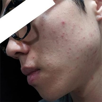 浙江綠城醫(yī)院整形美容中心丁路醫(yī)生做激光祛痘效果怎么樣，附案例對比圖