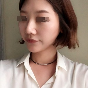 太原麗都整形醫(yī)院劉晉艷醫(yī)生做光纖溶脂瘦臉怎么樣？附案例效果對(duì)比圖