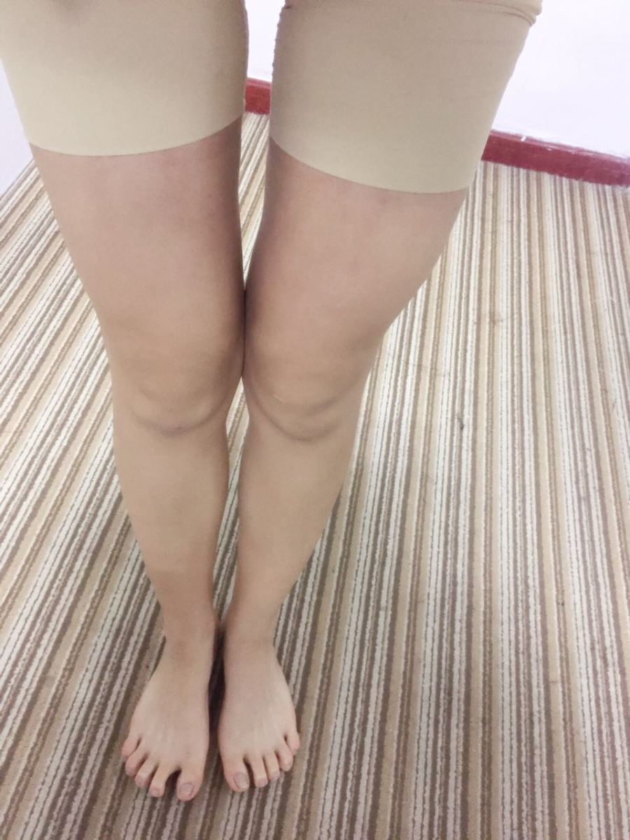 北京蒂凡妮整形靳玉彪醫(yī)生做大腿吸脂怎么樣？附大腿吸脂案例效果對比圖