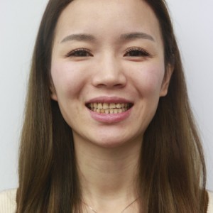 安慶渡江口腔醫(yī)院張良斌醫(yī)生牙齒貼面怎么樣？附牙齒貼面效果圖