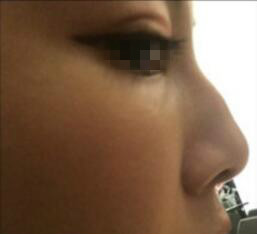 天津時光整形醫(yī)生盧丙侖做駝峰鼻怎么樣？附案例效果對比圖