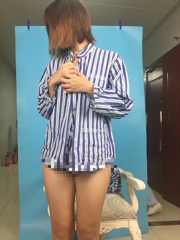 北京蒂凡妮整形靳玉彪醫(yī)生做大腿吸脂怎么樣？附大腿吸脂案例效果對比圖