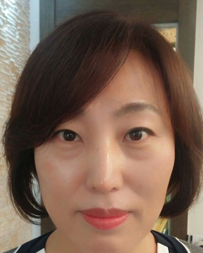 北京四季美學(xué)炫美整形醫(yī)生高玲做埋線祛眼袋怎么樣？附案例效果對(duì)比圖