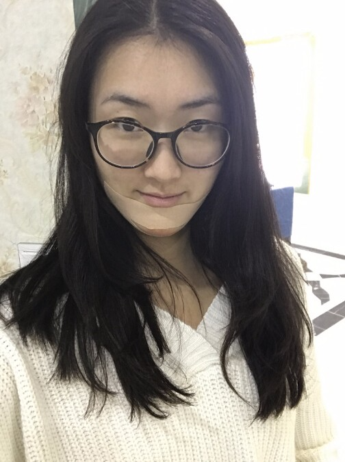 武漢中翰整形外科醫(yī)院做硅膠墊下巴怎么樣？附朱紅霞醫(yī)生案例效果對比圖