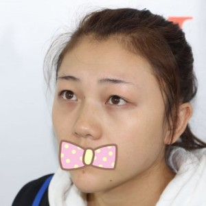 張家口維多利亞整形醫(yī)院張凱醫(yī)生做全切雙眼皮真實(shí)案例效果對(duì)比圖