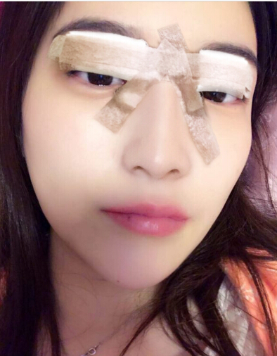 張家港唯恩整形醫(yī)院陳天杰醫(yī)生切開雙眼皮案例效果對比圖